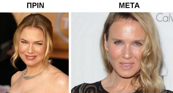 Renee Zellweger - Before and after