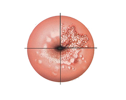 HPV 4